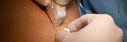 Procedures Using Surface Ultrasound Probes